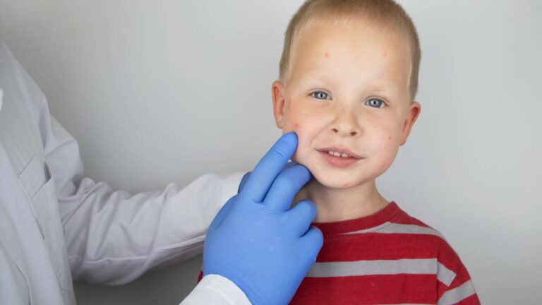 Pediatras Especialistas em Alergias Infantis na Vila Leopoldina e Região.